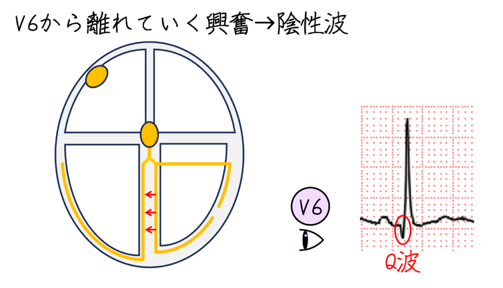 「V5、V6でq波」も誤りです。正常では心室中隔が左から右へ興奮するため、左側誘導に小さな中隔性q波を認めることがあります。