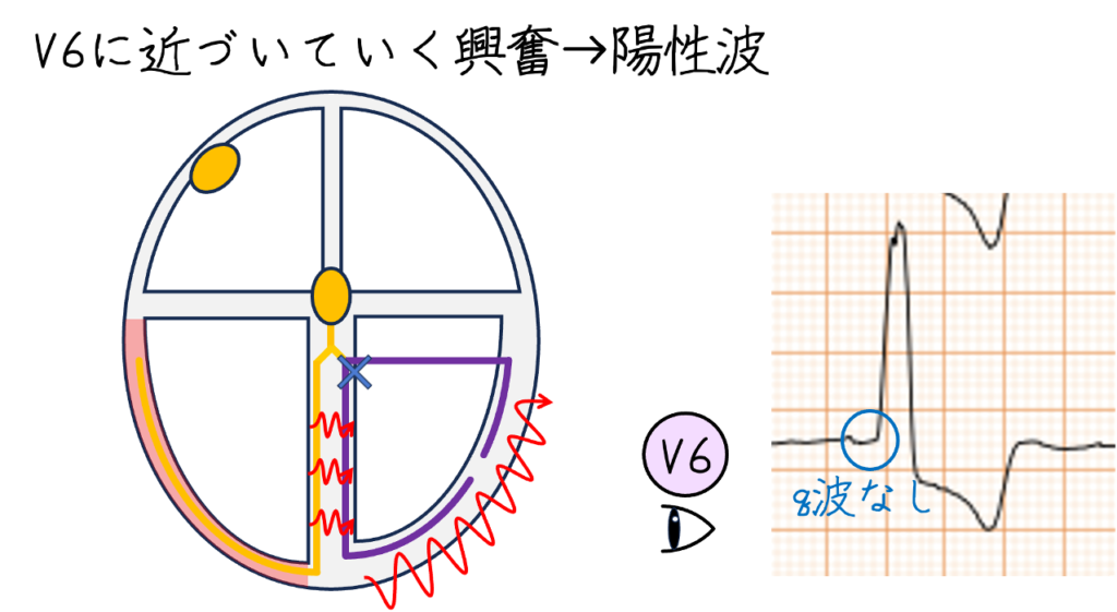 しかし左脚ブロックでは中隔の興奮順序が変化するため、I、V5、V6の正常な中隔性q波は通常消失します。