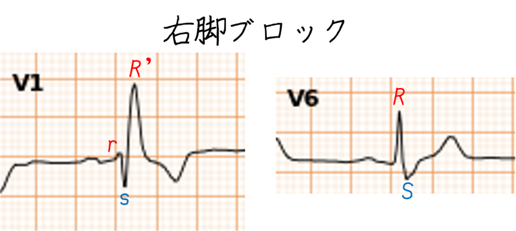 問題No.14
A:右脚ブロック
右脚ブロックでは、V1〜V2にrsR′、rSR′などの終末陽性成分(R′)が現れ、I・V6には幅広い終末S波を認めるのが典型です。今回の波形は逆で、V1が主に陰性、I・V5・V6が大きな陽性QRSとなっているため左脚ブロックを考えます。