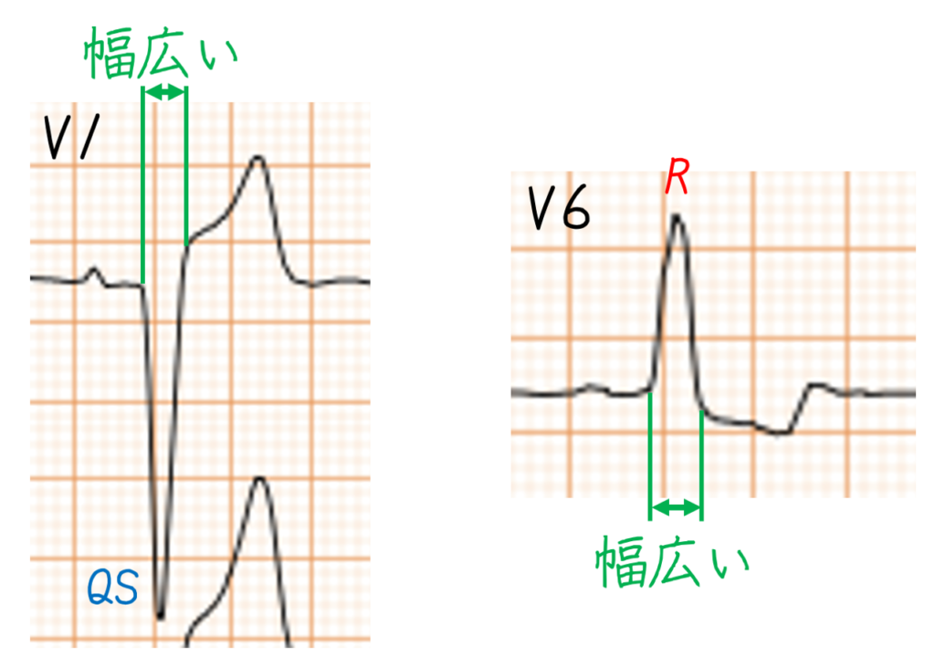 問題No.15
特に診断の手がかりになるのがV1とV6の形です。この心電図では、V1〜V3でQRS波は主に陰性で、特にV1では幅広く深い陰性QS波を認めます。一方、I、aVL、V5、V6では幅広いR波がみられます。