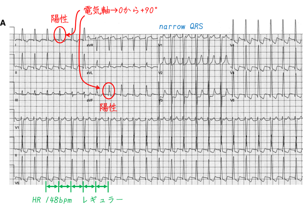 問題No.16
心電図Aは148bpmの規則的なリズムを示しています。QRS波は正常な持続時間(0.08秒)と正常な形態を示しています。I誘導とaVF誘導で陽性のQRS波であり電気軸は0°から+90°の間で正常です。QT/QTc間隔は正常です(280/440ミリ秒)。