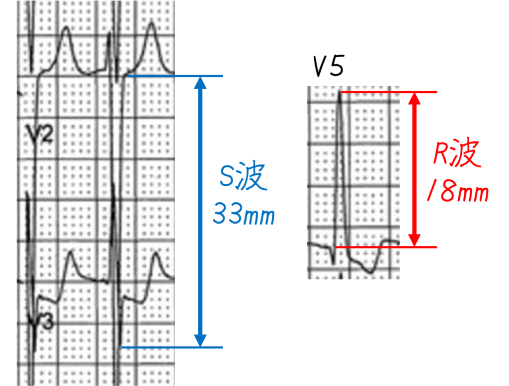 問題No.16
V2のS波が33mmで、V5のR波が18mmで、QRS波の振幅が増加しています。SV2+RV5=51mmは、左室肥大の基準(SV2+RV5 ≥35mm)の1つを満たしています。