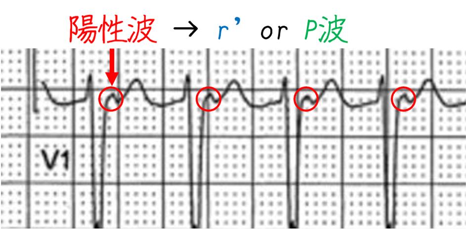 問題No.16
QRS波の前後に明らかなP波は認められません。しかし、QRS波の終末部に小さな陽性波形が重なってており、これはV1誘導で最もよく観察されます。これはR’波を表している可能性もあれば、P波である可能性もあります。これが重なったP波であるかどうかにかかわらず、明確なP波が認められないため、このリズムはno RP頻拍と呼ばれます。このタイプの頻拍の最も可能性の高い原因は、典型的な房室結節リエントリー性頻拍です。