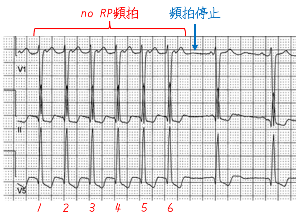 頸動脈洞マッサージ中に記録された心電図Bはこの頻拍の停止を示しています。最初の6つのQRS波は規則的で、心拍数は148bpmです。 QRS波は心電図AのQRS波と同じ持続時間、形態、軸、およびQT/QTc間隔を有しています。これはno RP頻拍であり、心電図Aに見られる不整脈と同一です。頻脈は6番目のQRS波の後に突然停止します。