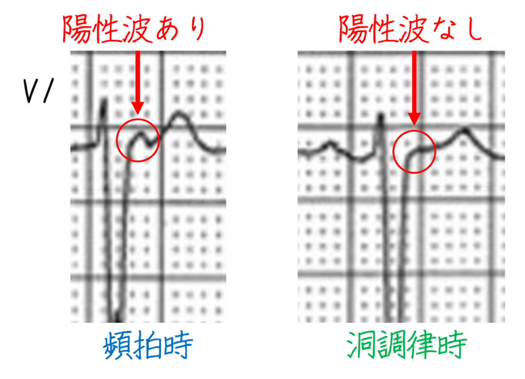 頻脈中のQRS波の終末には陽性波があり、これは洞調律時のQRS波には見られません。したがって、これはQRS波に重なった逆行性P波である可能性が高いことを示しています。