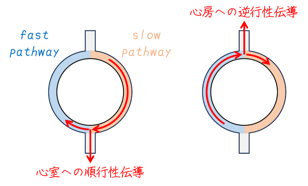 房室結節回帰性頻拍は、房室結節に2つの伝導路が存在することによって生じます。すなわち、不応期が短い遅伝導路と、不応期が長い速伝導路です。典型的な房室結節性頻拍では、心室への順行性伝導は遅伝導路を介して行われ、心房への逆行性伝導は速伝導路を介して行われます。